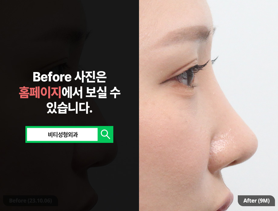 True Satisfaction Comes Only When You Achieve Both Function and Aesthetics in Nose Surgery! image 1