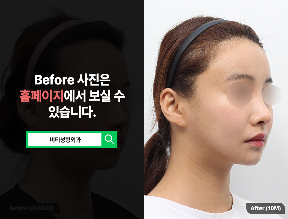 추구미에 딱 맞는 윤곽성형✨ 비티 퍼스널 안면윤곽 관련 이미지 2