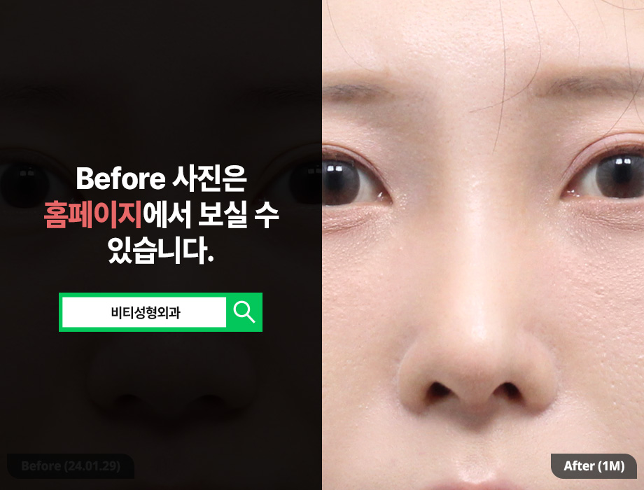 Can donated rib cartilage nose surgery improve a bulbous nose and the nasolabial angle, too? image 3