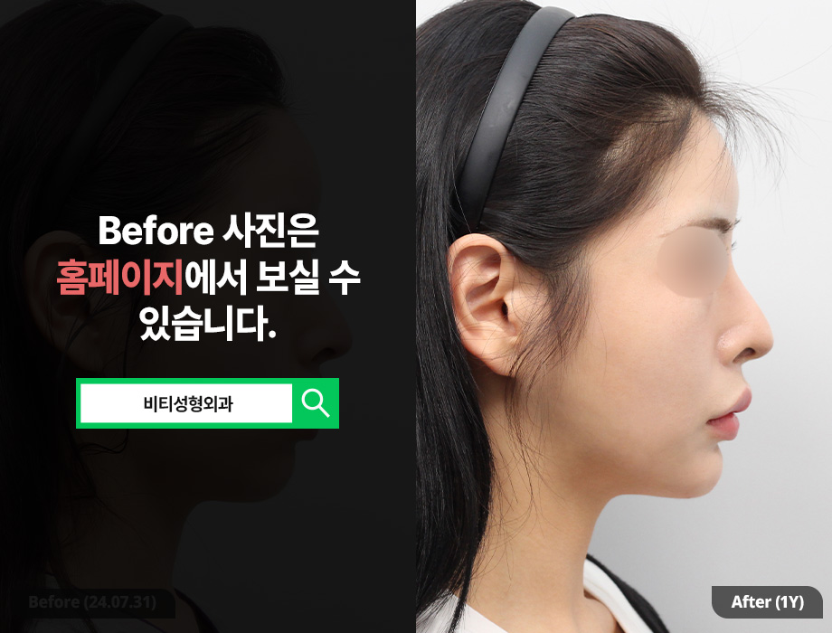 Three Types of Contouring Surgery: Three Structural Reasons the Face Looks Smaller image 3