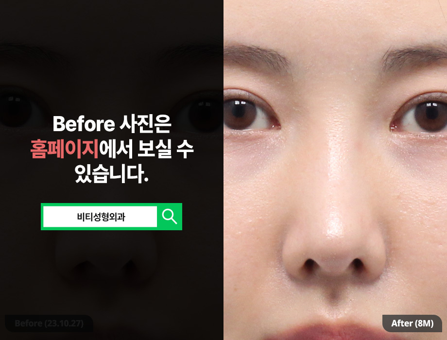 Drooping Nasal Tip.. Do You Really Need Revision Rhinoplasty? image 3
