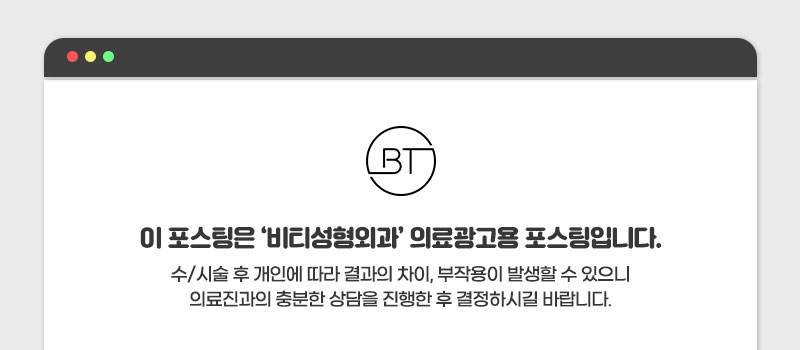 코재수술, 기능과 디자인 한번에! 기능미용코 4개월 찐후기 관련 이미지 12