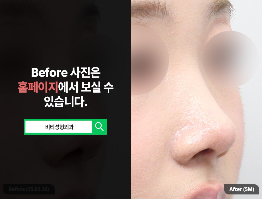 코성형 후 들창코? 자가늑+무보형물로 코재수술 관련 이미지 2