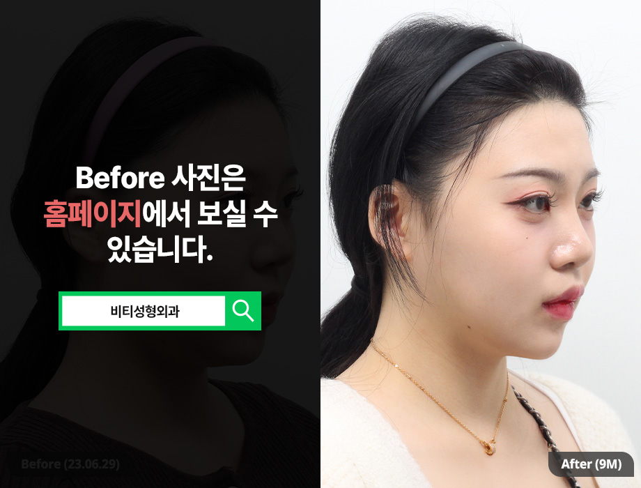 윤곽 3종 수술 효과 극대화하는 법 궁금하다 관련 이미지 2