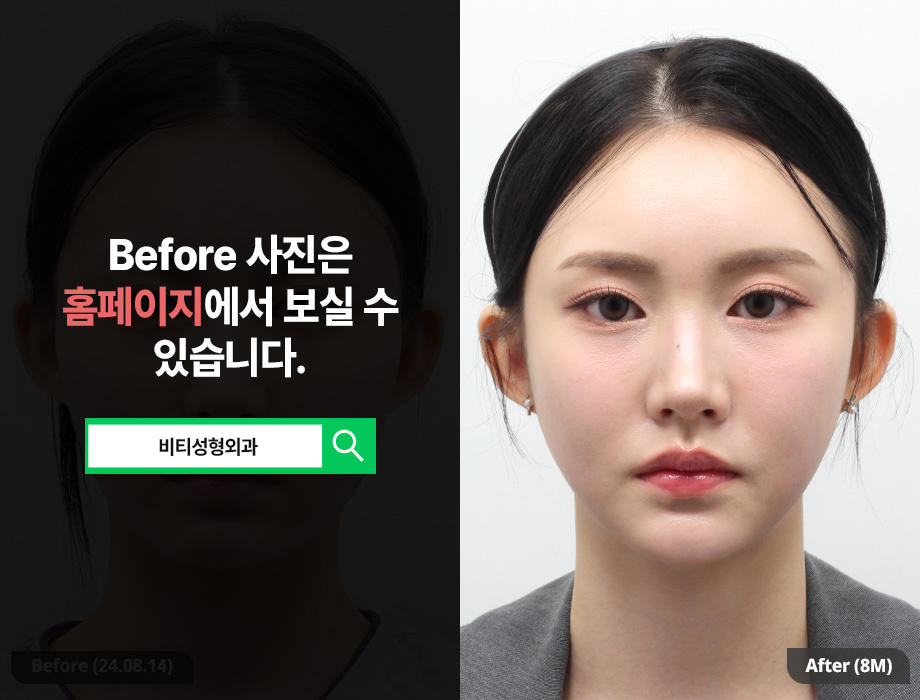 [비티성형외과] 자려한 윤곽 3종 | 자연스러우면서 화려한 V라인, 8개월 찐후기 관련 이미지 1