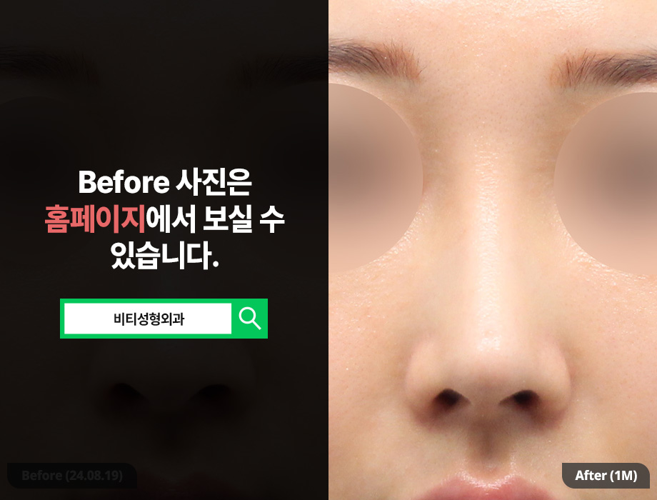 코 재수술, 기증늑연골로 긴코 교정한 케이스? 관련 이미지 3
