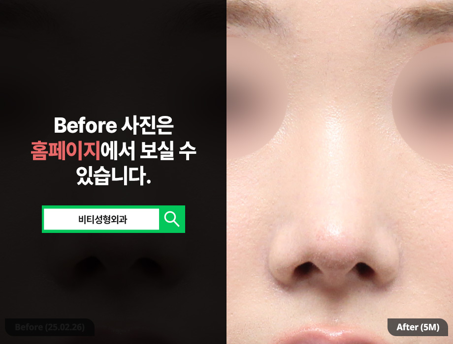 코성형 후 들창코? 자가늑+무보형물로 코재수술 관련 이미지 3