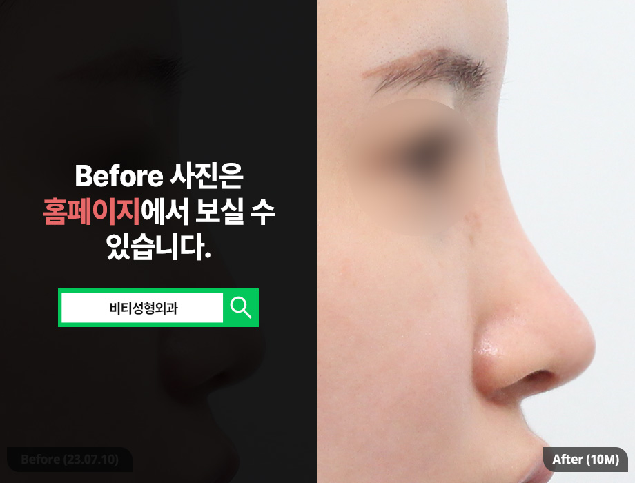 Before-and-after comparison of raising a low, drooping nose over 10 months✨ (ft. donated rib cartilage, columella lifting) image 1