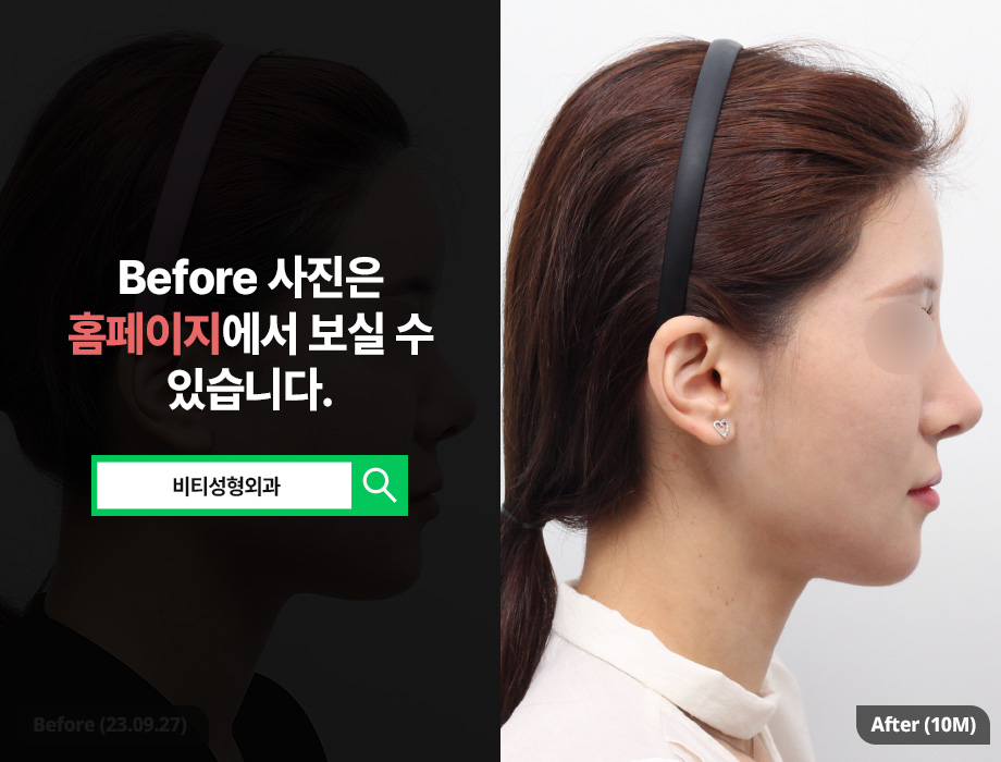 사각턱&턱끝 수술 후기｜윤곽 2종으로 갸름해진 얼굴 Before & After 관련 이미지 3