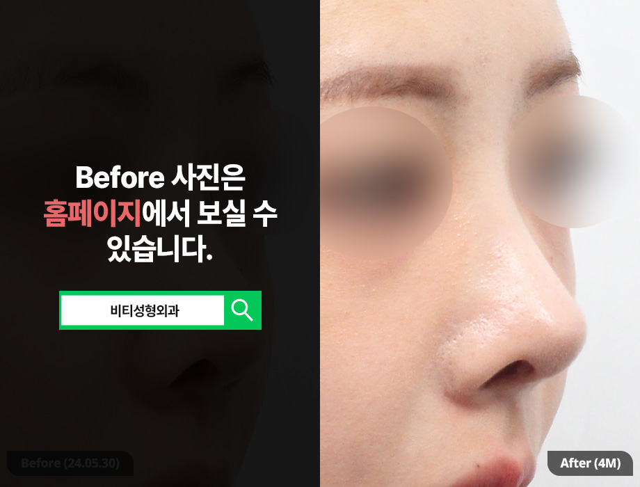 복코에 짧은 코까지, 재수술로 가능할까? 관련 이미지 2