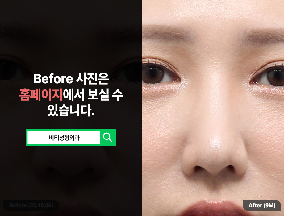 True Satisfaction Comes Only When You Achieve Both Function and Aesthetics in Nose Surgery! image 3