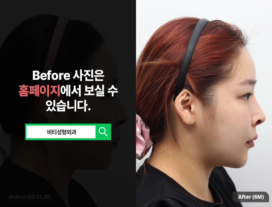 What Changes Can You Expect from Two-Procedure Facial Contouring: Cheekbone + Square Jaw? image 3