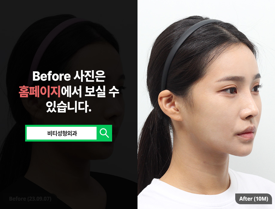 윤곽 수술 종류별 효과와 회복 기간까지 정리! 관련 이미지 2