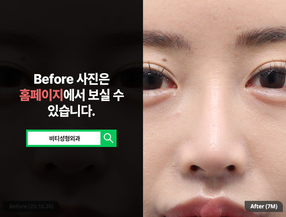 기증늑연골로 다시 태어난 코라인, 코재수술 7개월 후기+비용은? 관련 이미지 3