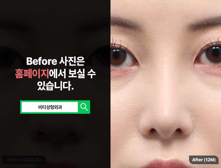 Bulbous Nose Rhinoplasty Is Not Solved by Simply Making It Higher image 3
