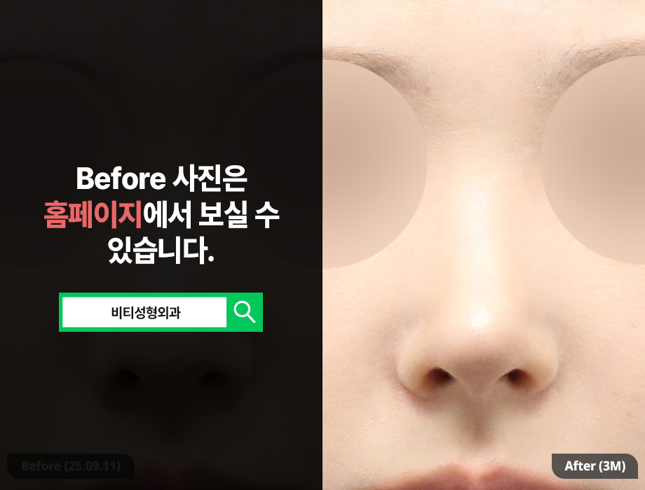 무보형물 코성형 노보코 3개월 후기🔥 매부리·복코·비순각까지 한번에 관련 이미지 3