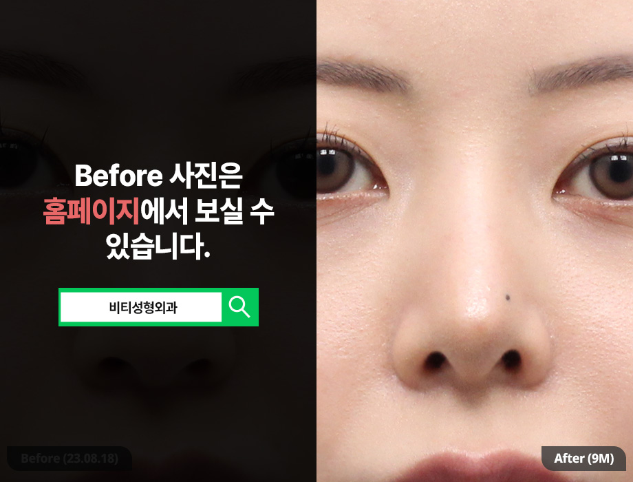 If You Want to Transform a Hump Nose and Bulbous Nose into a Glamorous Nose! image 3