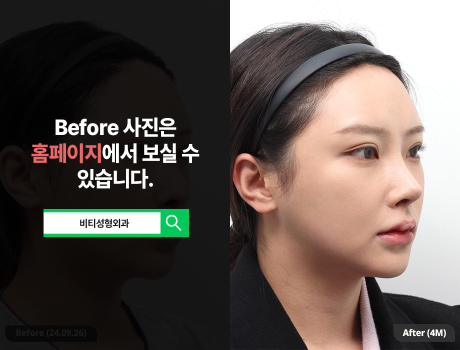 윤곽3종 + 이중턱 지방흡입 4개월 진짜후기!! 관련 이미지 2