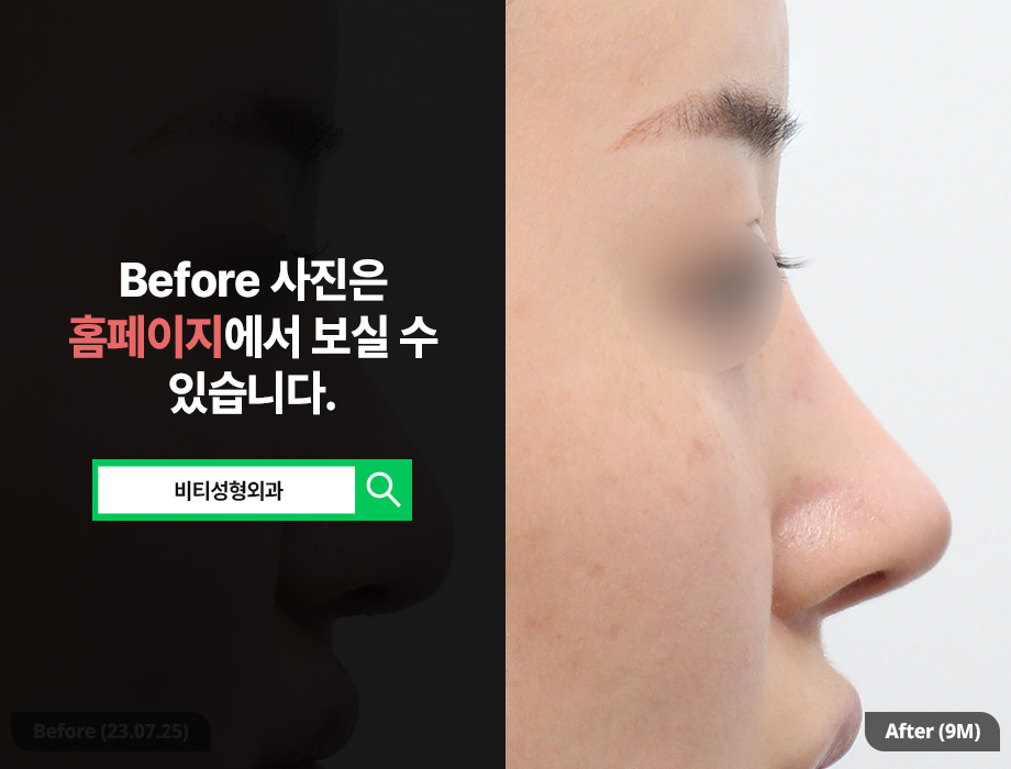 코 성형 후 코끝 처짐/떨어짐으로 재수술 고려한다면 관련 이미지 1