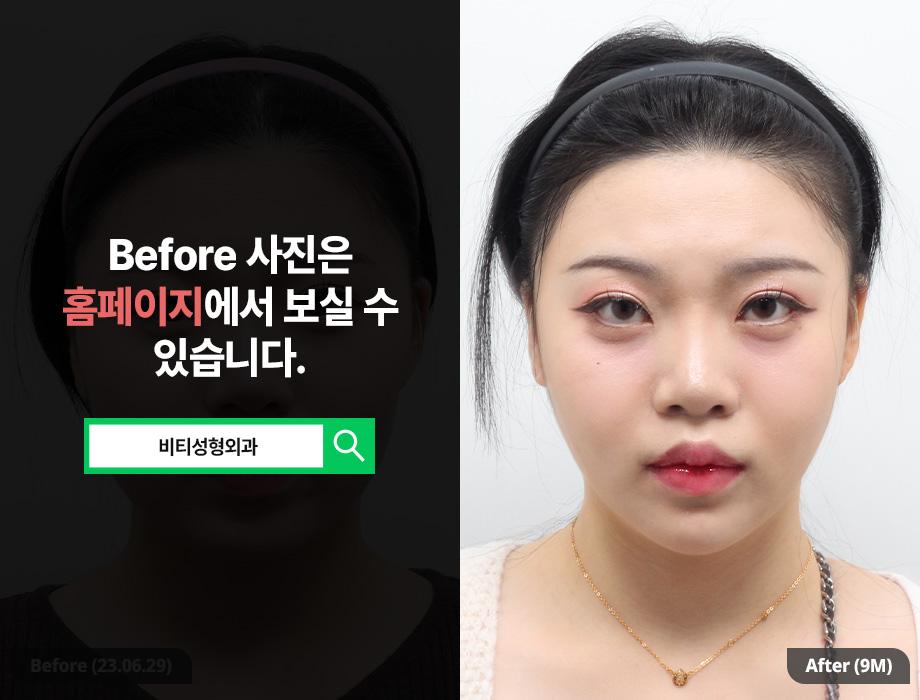 윤곽 3종 수술 효과 극대화하는 법 궁금하다 관련 이미지 1