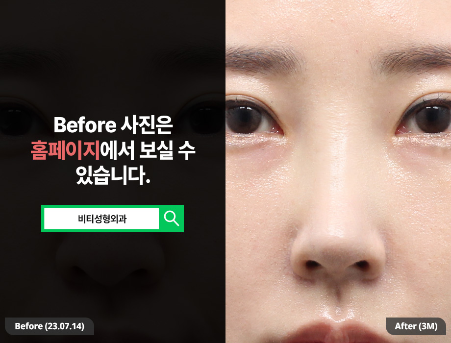 To Get Insurance Benefits and Cosmetic Nose Surgery Done at Once: Functional Aesthetic Rhinoplasty image 3