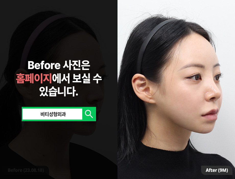 입체적인 얼굴형 만들기, 윤곽 3종 수술 전 꼭 알아야 할 것들 관련 이미지 2
