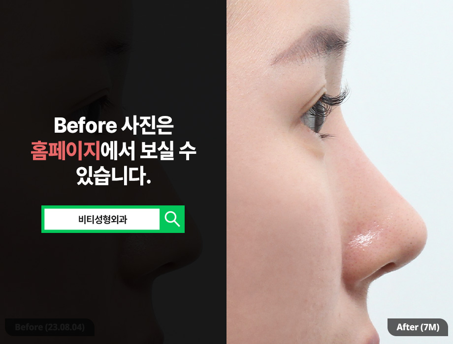 기증늑연골로 무보형물 매부리코 수술, 안전하고 자연스럽게 관련 이미지 1