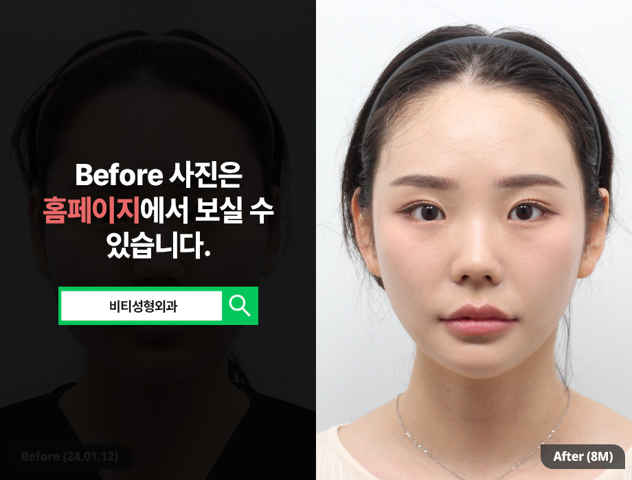 3-Part Facial Contouring, 8-Month Real Review After Long-Curved Square Jaw Surgery! image 1