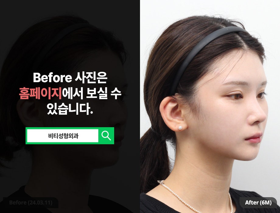 나에게 딱 맞춘 안면윤곽, 비티 퍼스널 라인🫧 관련 이미지 2