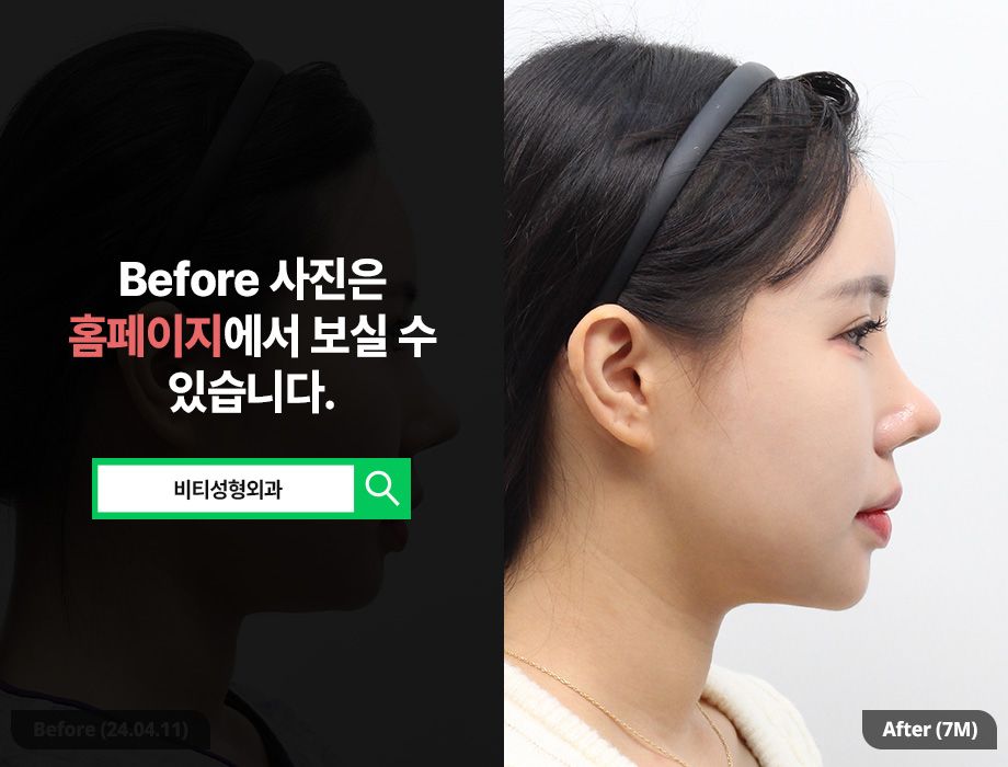 윤곽3종, 살 빼고 수술해야 더 예쁜 라인 나오는 이유 관련 이미지 3
