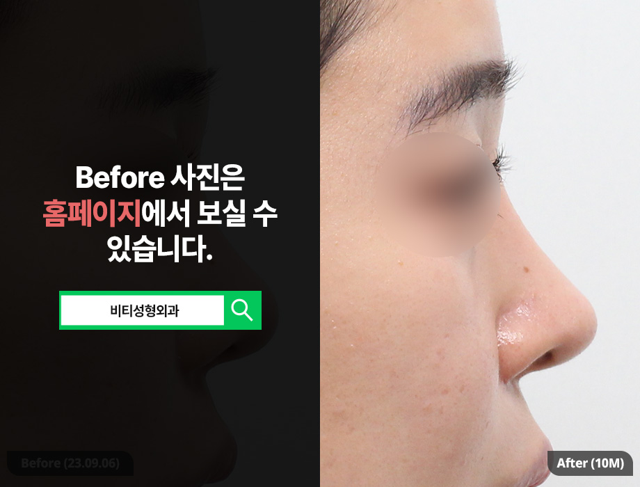 코 재수술, 왜 기증늑 연골이 필요한가? 복코, 콧볼까지 한 번에 해결! 관련 이미지 1