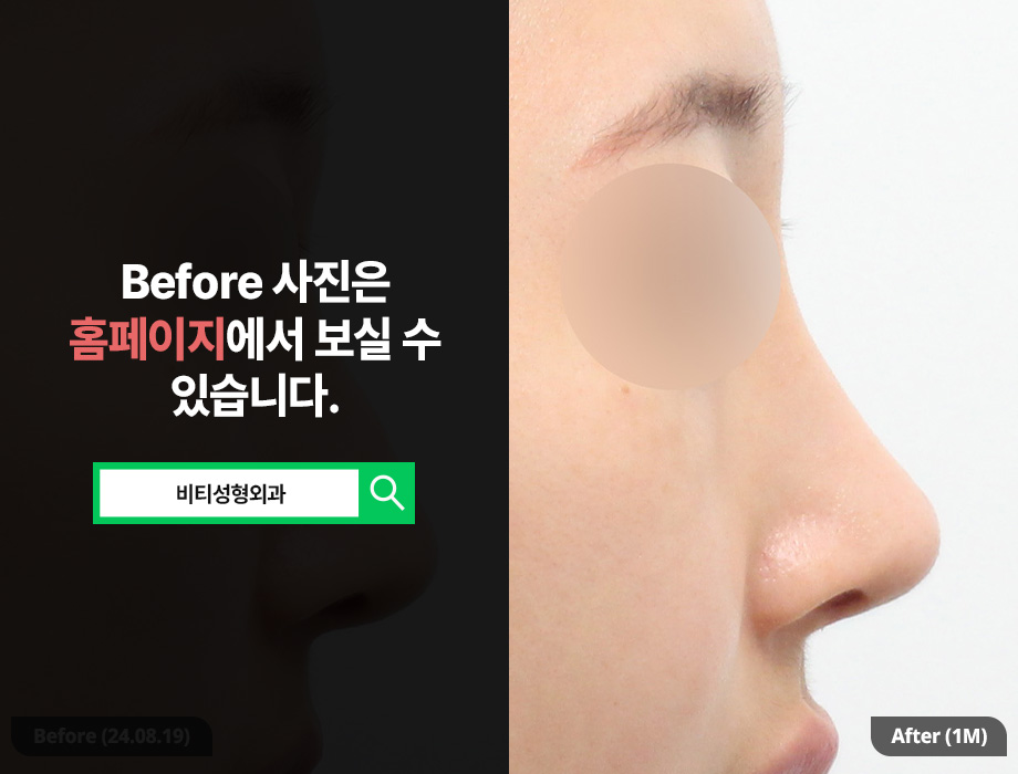 코 재수술, 기증늑연골로 긴코 교정한 케이스? 관련 이미지 1