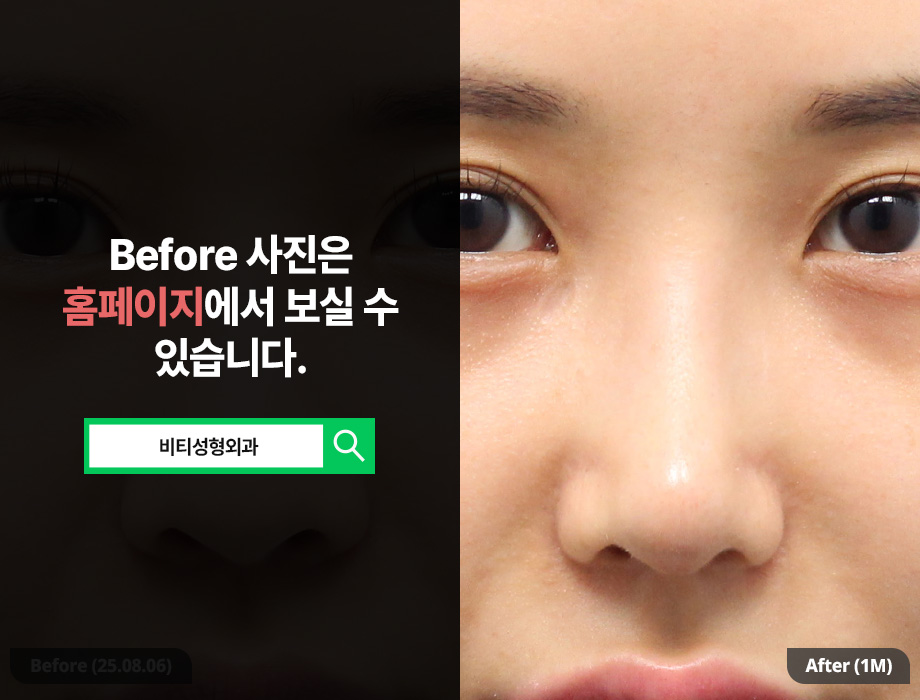 Easy breathing, a pretty line as a bonus! Functional-aesthetic rhinoplasty using donated rib cartilage A to Z image 3