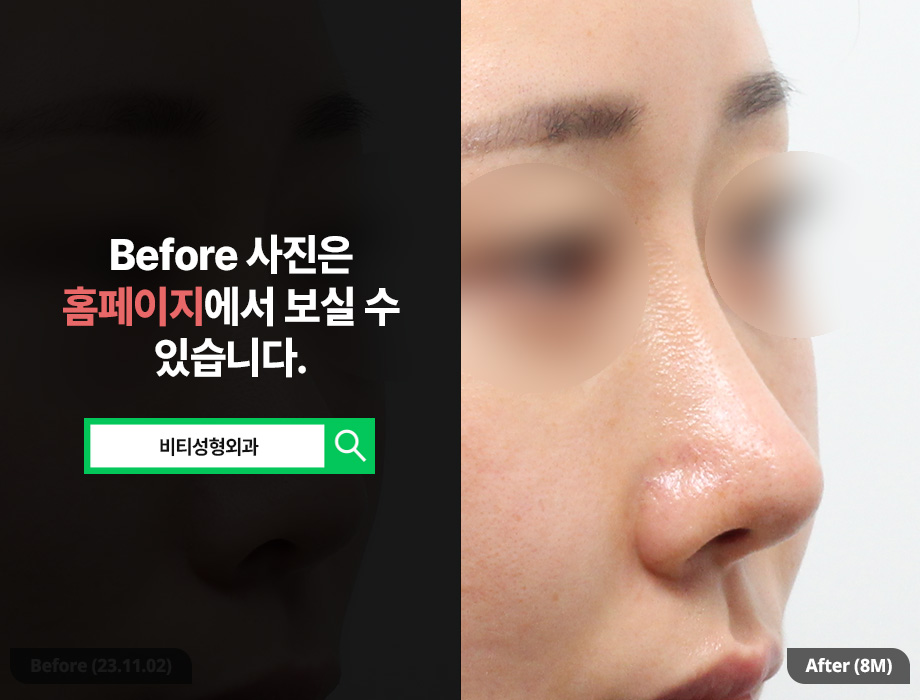 Broad Nose + Long Nose: Stable Rhinoplasty with Donated Rib Cartilage (8-Month Real Review) image 2