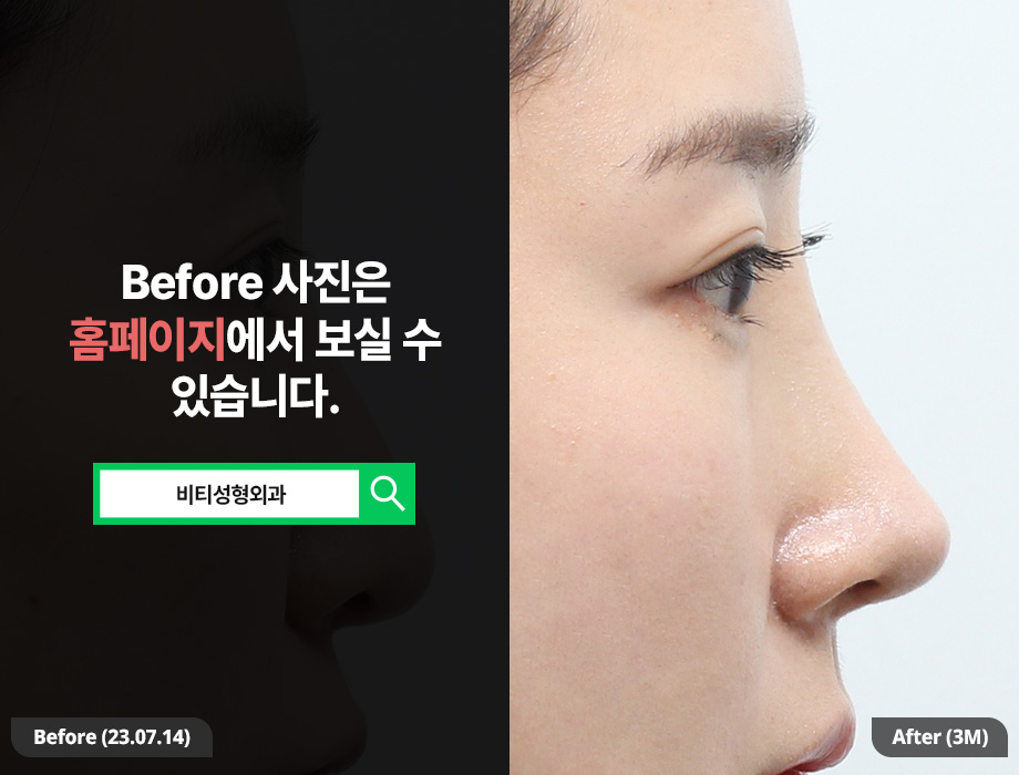 To Get Insurance Benefits and Cosmetic Nose Surgery Done at Once: Functional Aesthetic Rhinoplasty image 1