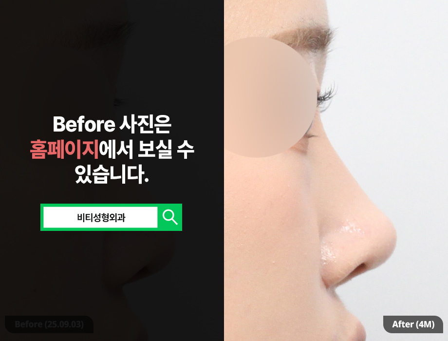 코재수술, 실패 원인 분석부터 재료까지 | 4개월차 성공 사례 관련 이미지 1