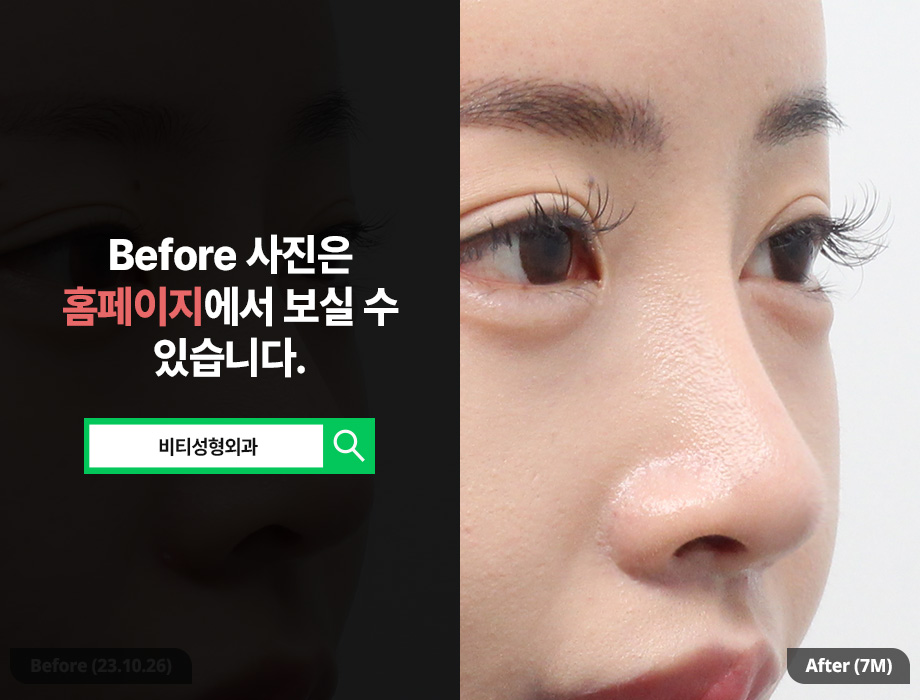 기증늑연골로 다시 태어난 코라인, 코재수술 7개월 후기+비용은? 관련 이미지 2