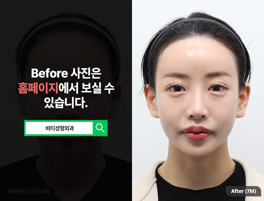 I Changed My Face Shape with Square Jaw + Chin Surgery (Real Review of Facial Contouring 2 Procedures) image 1