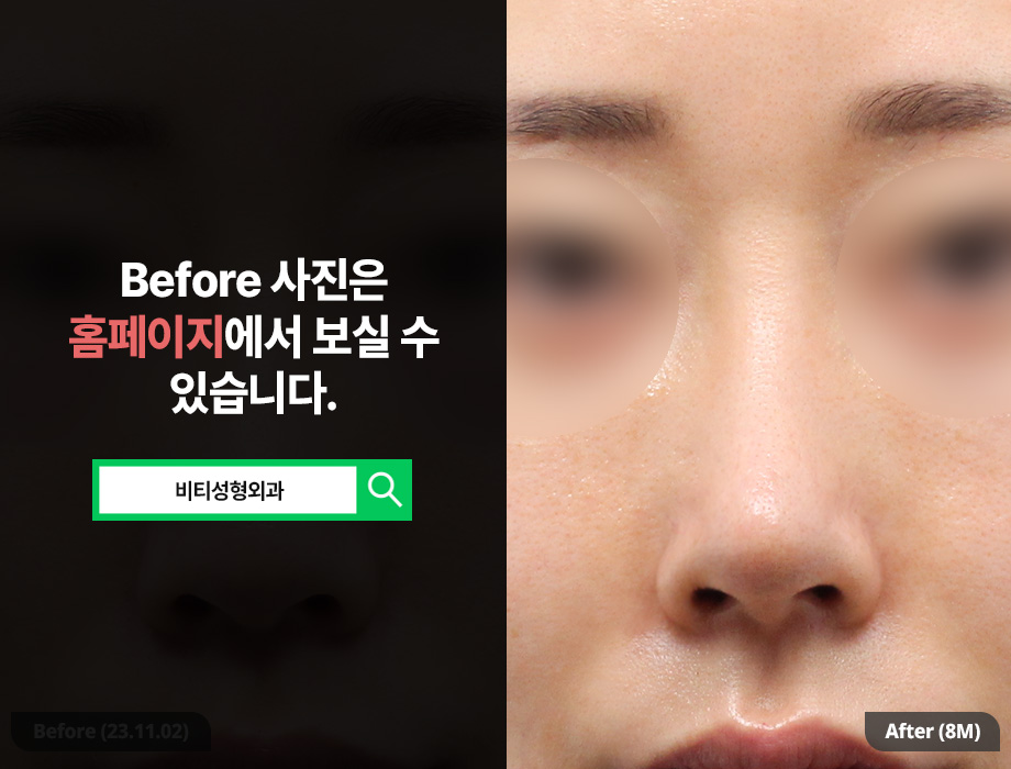 Broad Nose + Long Nose: Stable Rhinoplasty with Donated Rib Cartilage (8-Month Real Review) image 3