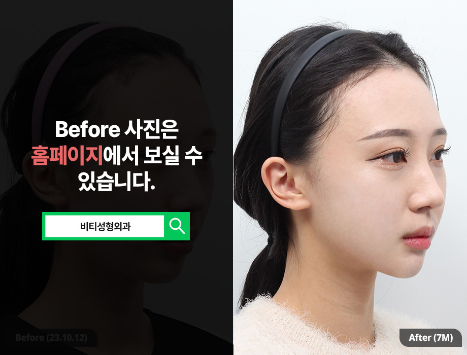 무턱+비대칭 얼굴형, 윤곽 3종으로 개선 가능할까? 관련 이미지 2