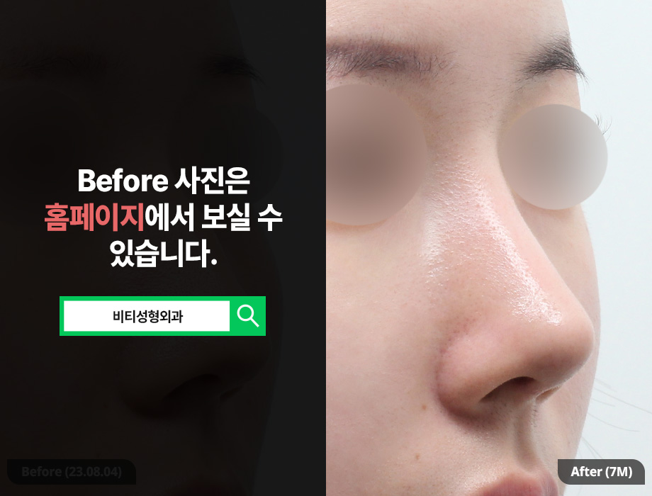 기증늑연골로 무보형물 매부리코 수술, 안전하고 자연스럽게 관련 이미지 2