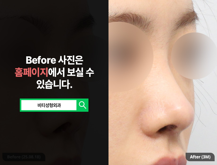 No More Failures! How to Choose a Clinic for Revision Nose Surgery? image 2