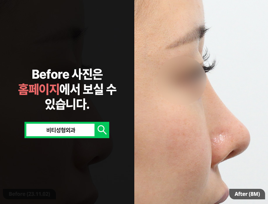 Broad Nose + Long Nose: Stable Rhinoplasty with Donated Rib Cartilage (8-Month Real Review) image 1