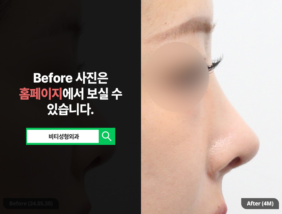 복코에 짧은 코까지, 재수술로 가능할까? 관련 이미지 1