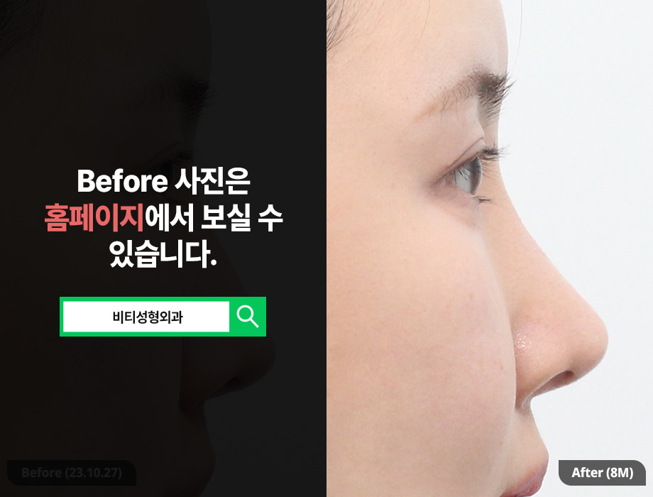 Drooping Nasal Tip.. Do You Really Need Revision Rhinoplasty? image 1