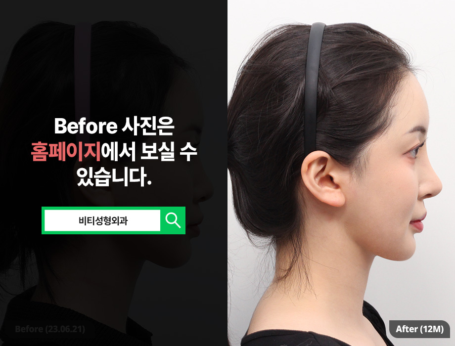 환자에게 딱 맞춘 안면윤곽 효과 관련 이미지 3
