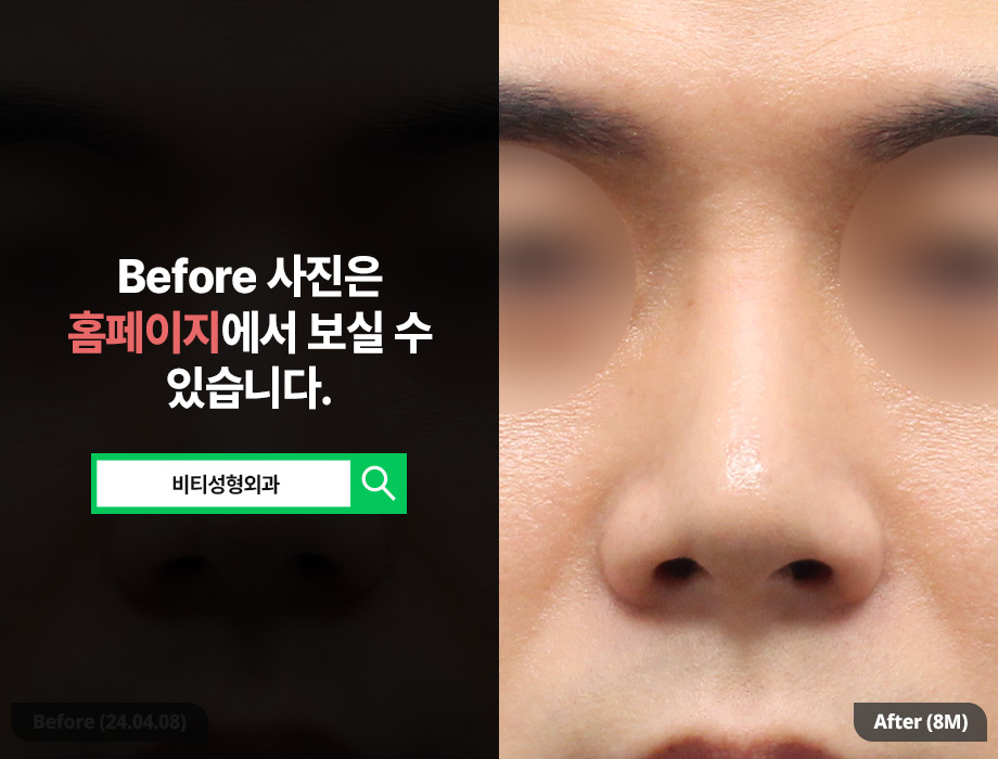 남자코 고민이라면? 매부리부터 실제거까지 한 번에 관련 이미지 3
