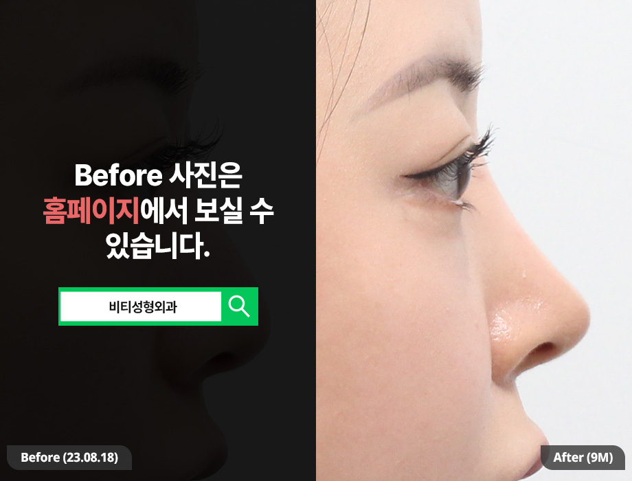 If You Want to Transform a Hump Nose and Bulbous Nose into a Glamorous Nose! image 1