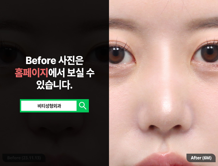 귀연골 코성형, 자연스러움을 원한다면? 6개월 리얼후기 관련 이미지 3