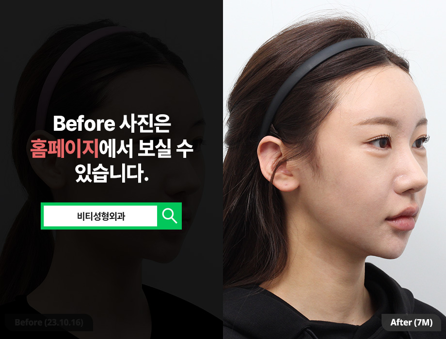 Why Choose Contouring Surgery Instead of Filler? The Differences and Effects of the 3 Procedures image 2